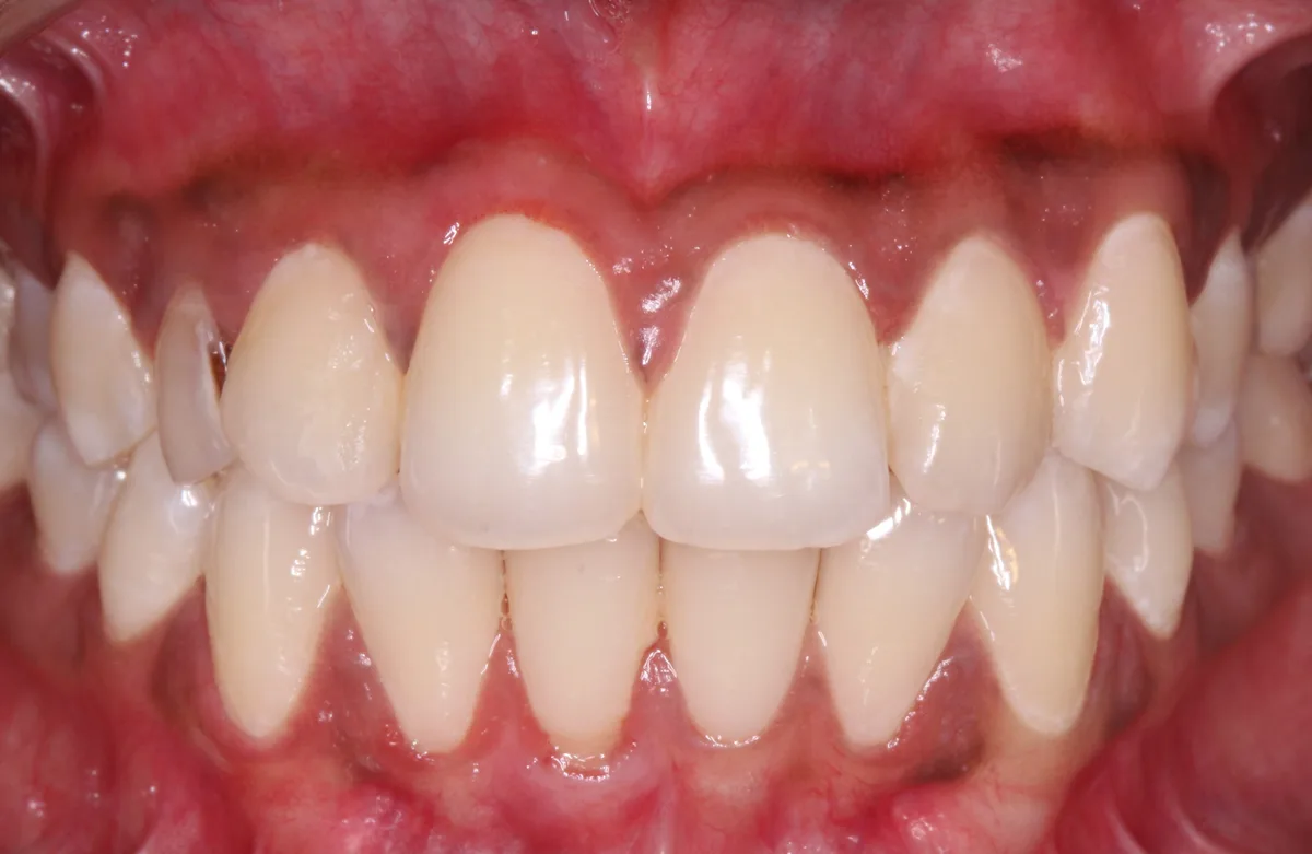 After — Pregnancy Gingival Hyperplasia