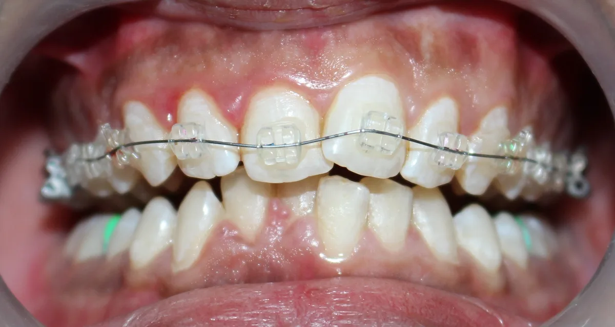 Ceramic Braces