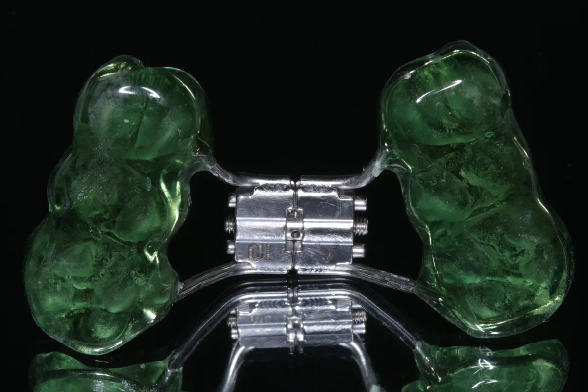 Rapid Maxillary Expansion
