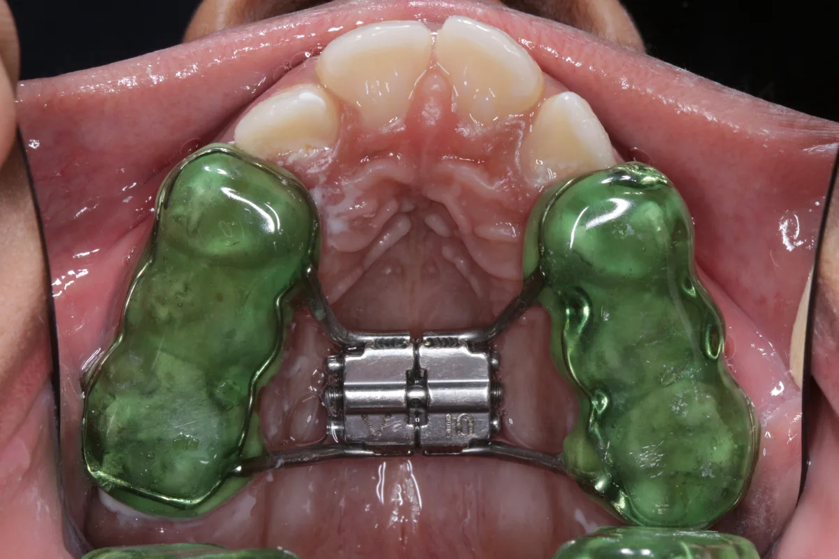 After — Rapid Maxillary Expansion