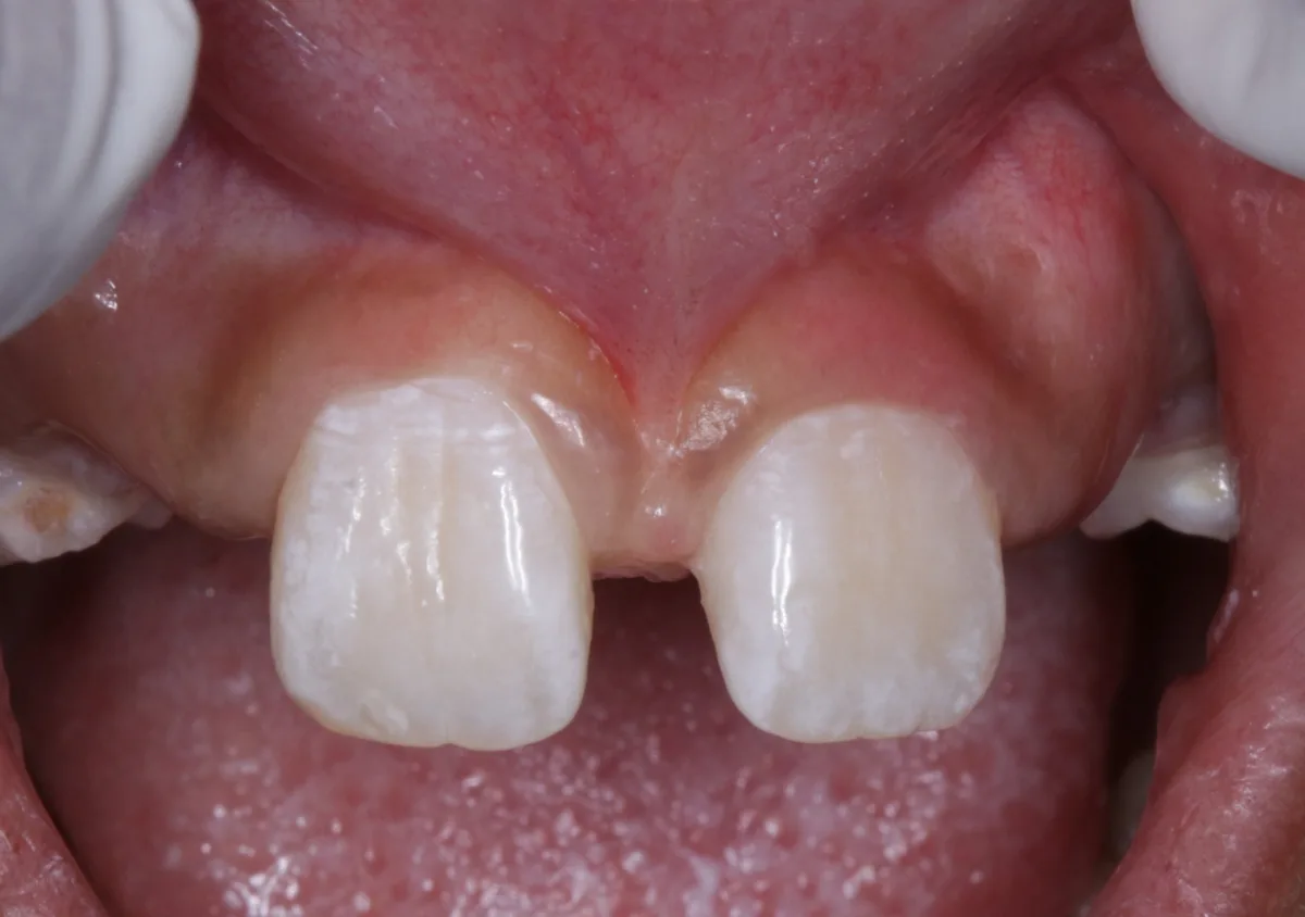 Periodontal Frenectomy