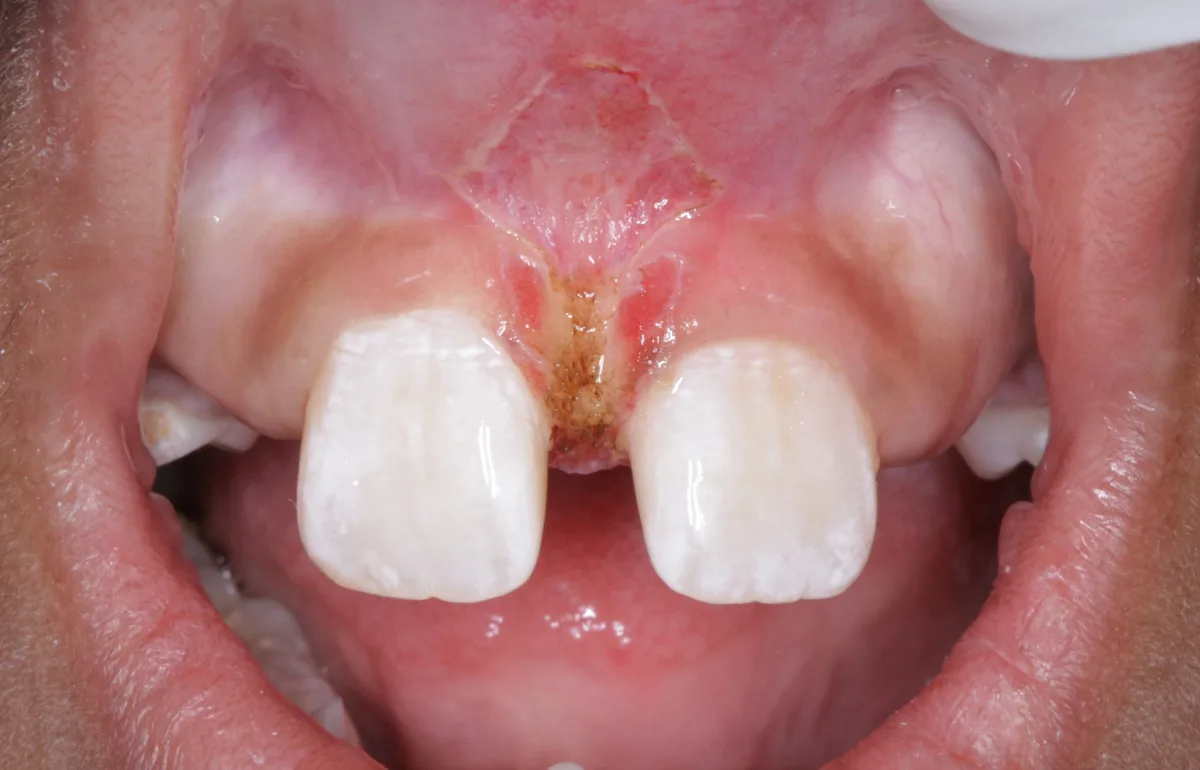 After — Periodontal Frenectomy