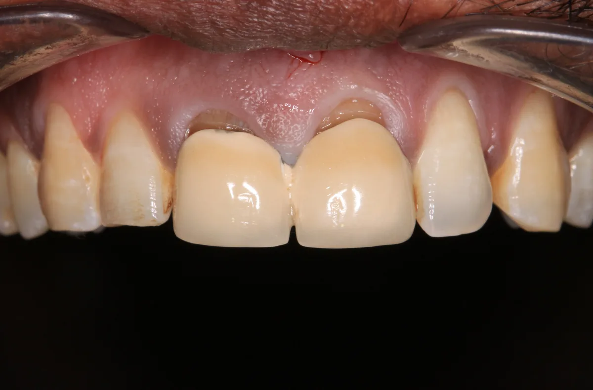 CAD/CAM Anterior Crowns