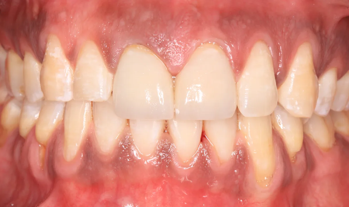 After — CAD/CAM Anterior Crowns