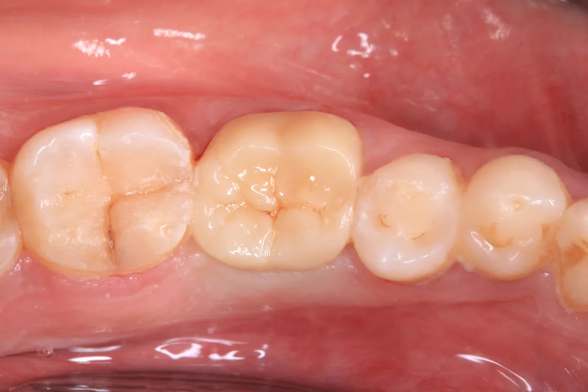 After — CAD/CAM Zirconia Crowns