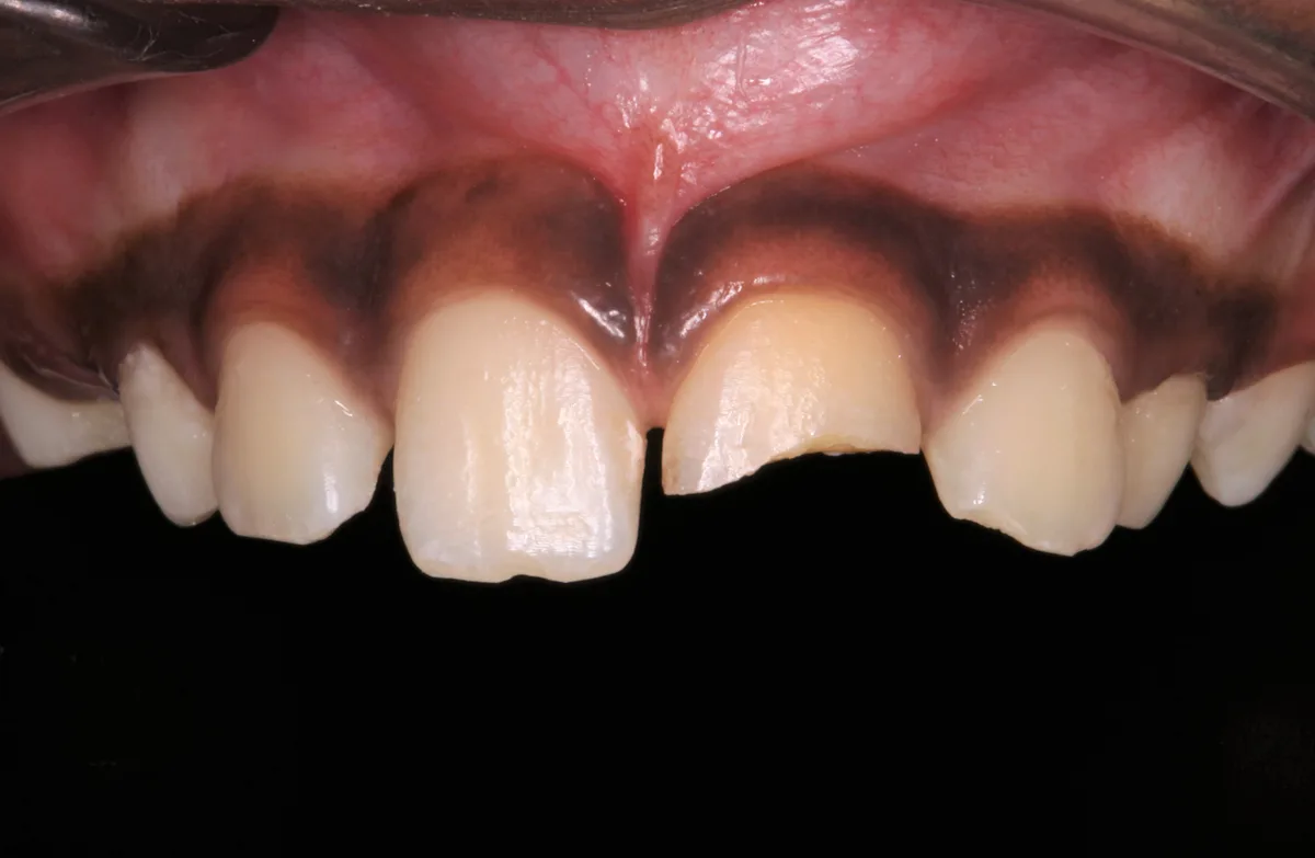 Fractured Tooth Management