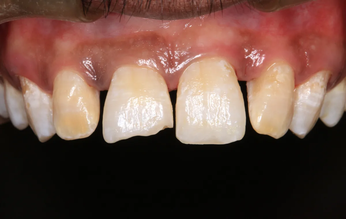 Fractured Tooth Management
