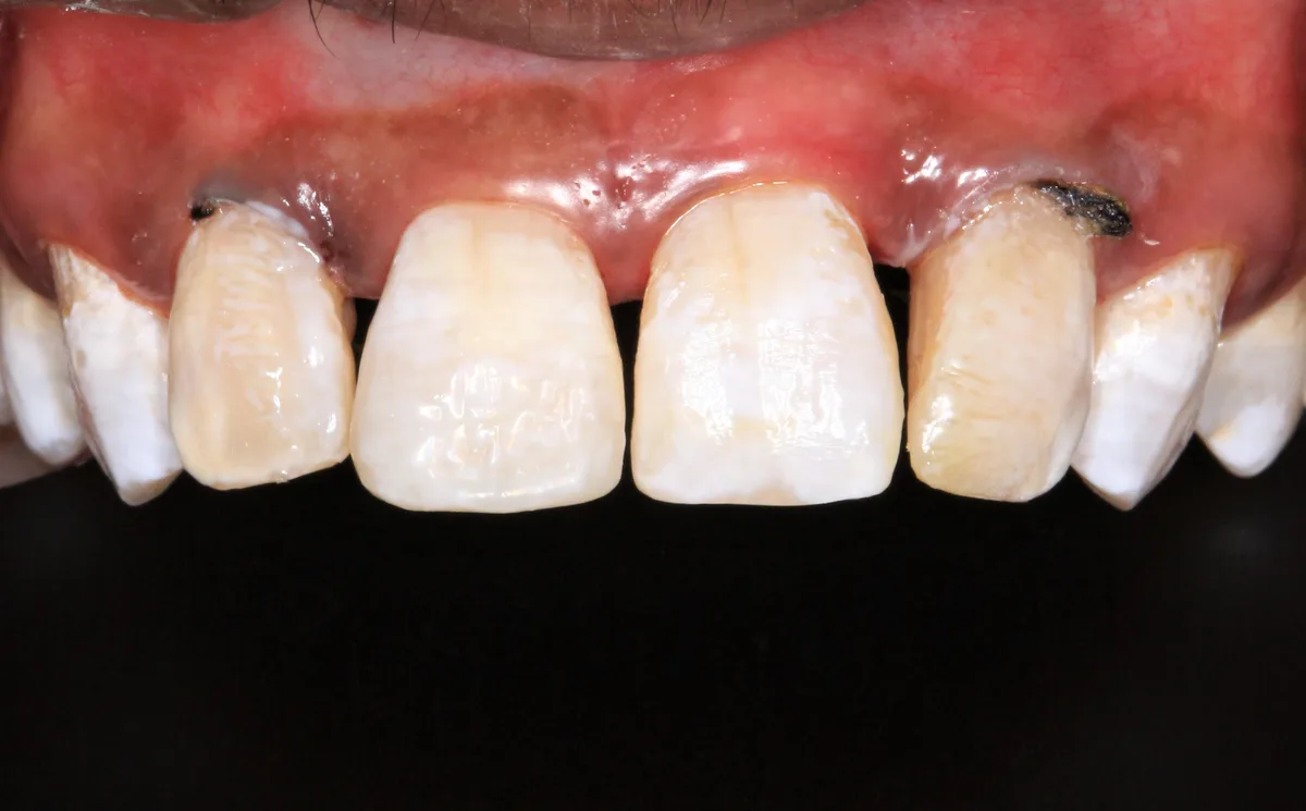 After — Fractured Tooth Management