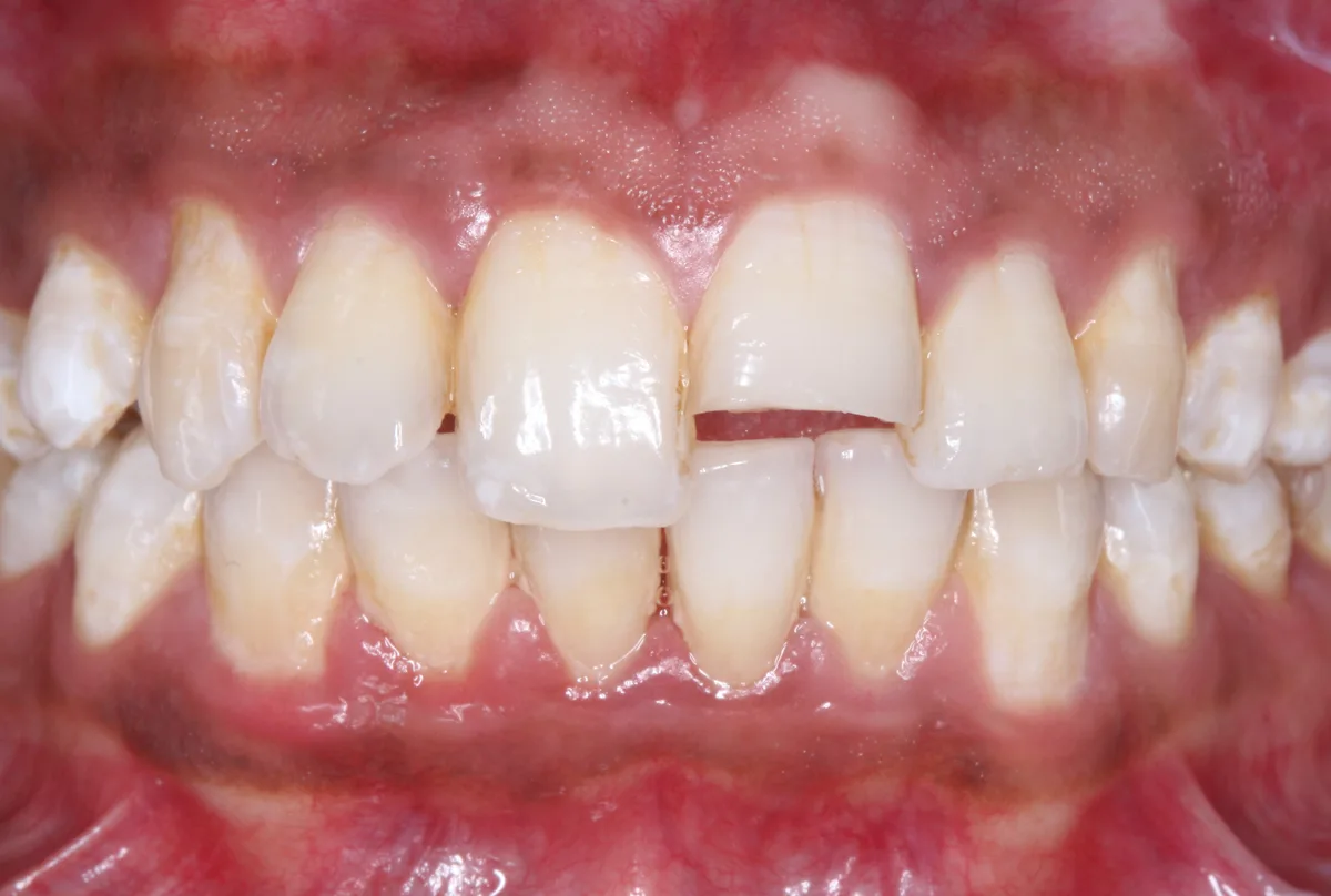 Fractured Tooth Management