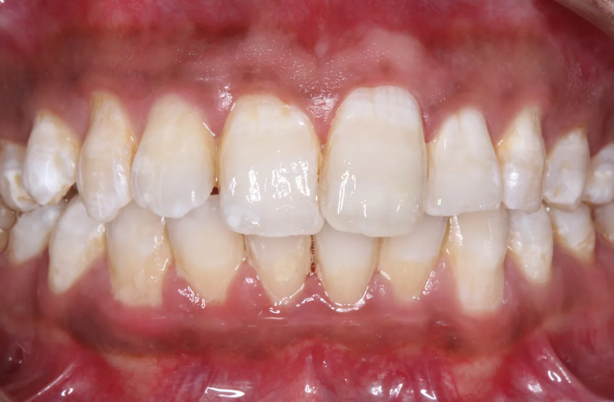 After — Fractured Tooth Management