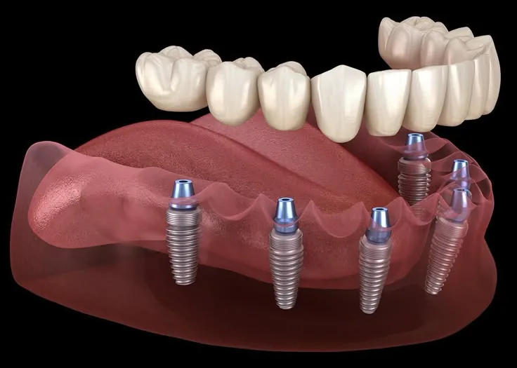 Implant Dentistry treatment at DentiQ